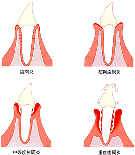 歯周病進行