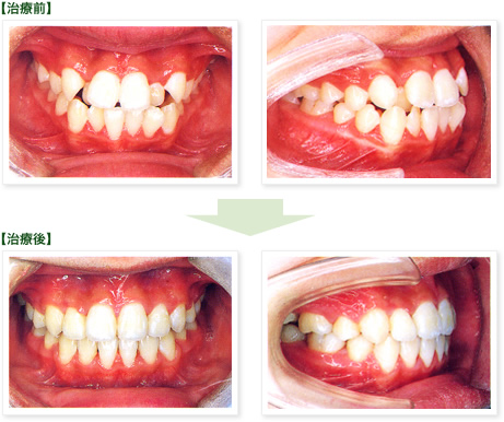 矯正歯科、治療前→治療後