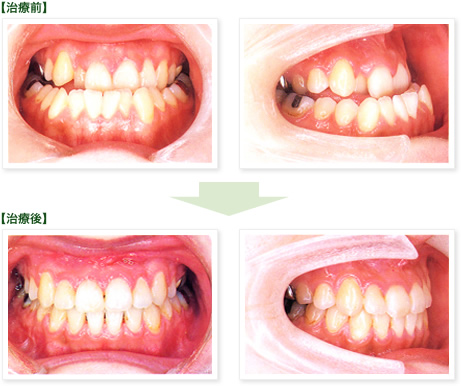 矯正歯科、治療前→治療後
