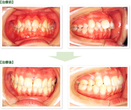 矯正歯科、治療前→治療後