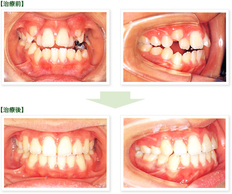 矯正歯科、治療前→治療後